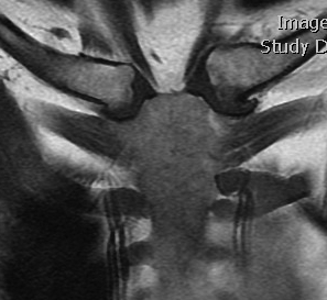 SCJ OA MRI 1